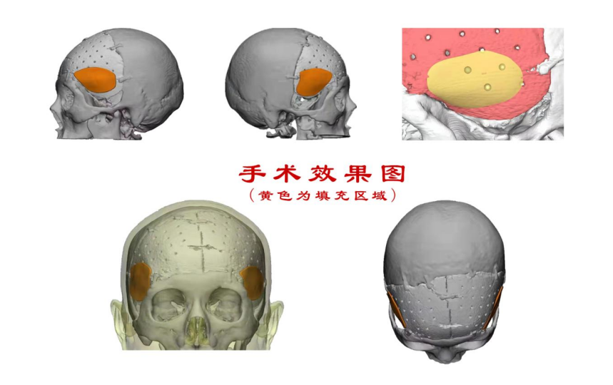 林志穎車(chē)禍致顏面骨折，醫(yī)生：或可用3D打印建模進(jìn)行術(shù)后修復(fù)