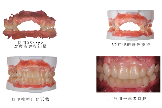 3Shape彩色工作流程，讓牙齒假體越來越“真”！