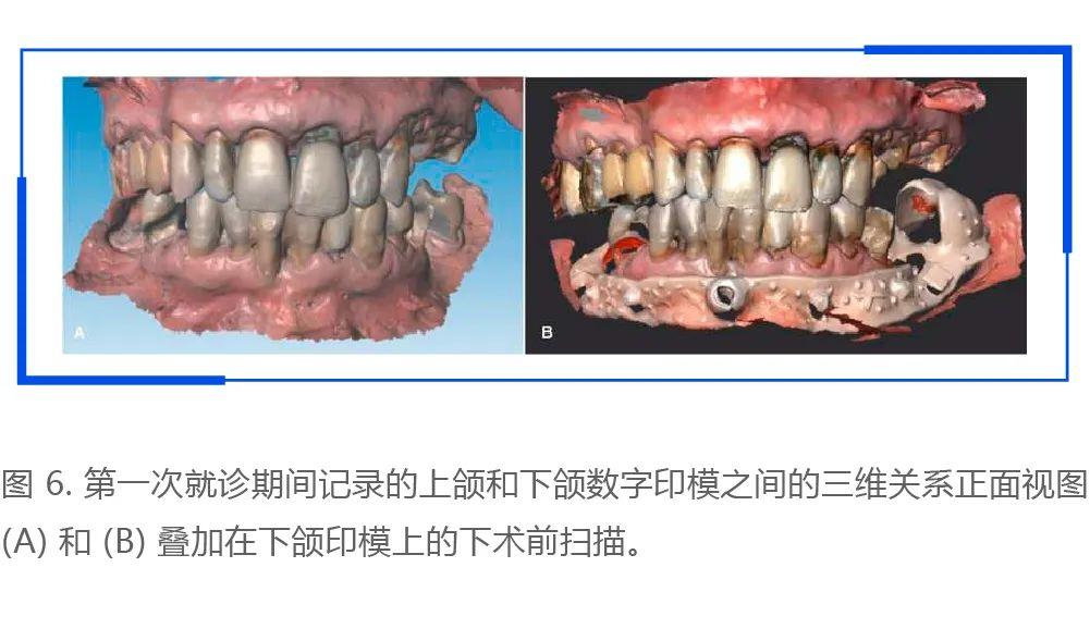 利用口腔掃描儀進(jìn)行術(shù)前口內(nèi)掃描和數(shù)字化設(shè)計(jì)